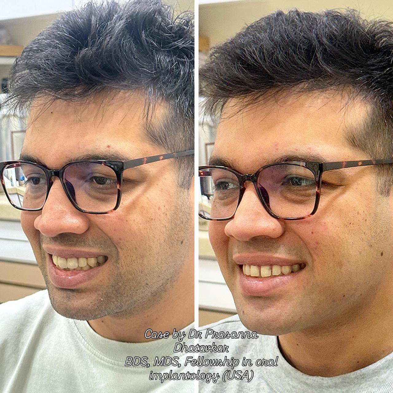 Cosmetic bonding case at Urban Smiles Dental Care
